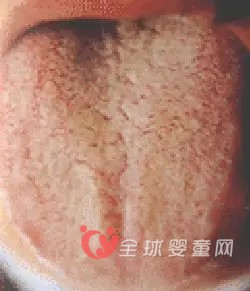 宝宝出现舌苔厚黄是什么情况？