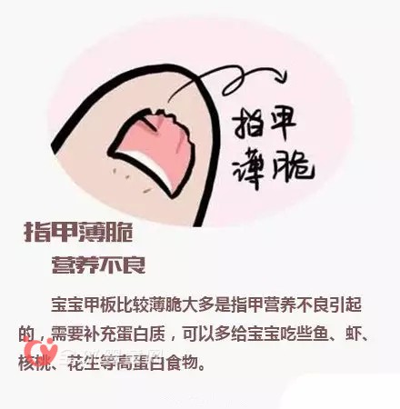 宝宝指甲透露出来的健康问题 爸爸妈妈注意到了吗？
