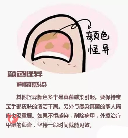 宝宝指甲透露出来的健康问题 爸爸妈妈注意到了吗？
