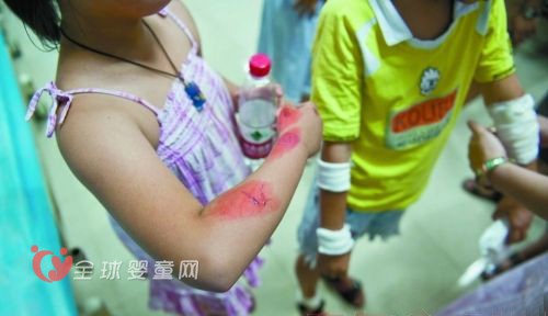 孩子皮外伤怎么处理 教妈妈3个绝招