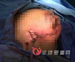 高龄产妇乳房出现问题 网上寻偏方导致乳房腐烂
