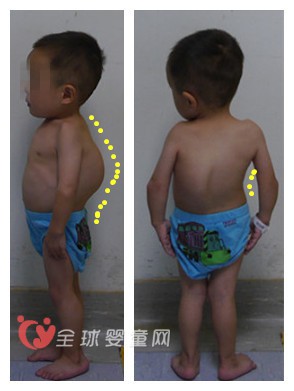 孩子的脊柱侧弯是爸爸妈妈应该注意的焦点