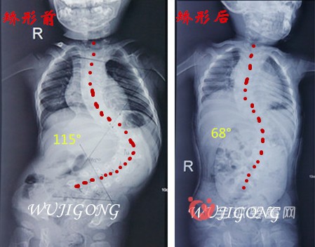 孩子的脊柱侧弯是爸爸妈妈应该注意的焦点