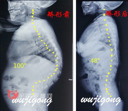 孩子的脊柱侧弯是爸爸妈妈应该注意的焦点