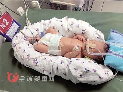 身高88厘米袖珍妈妈生下宝宝 生产手术只能用儿童型号