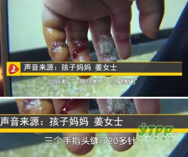 2岁男孩摸了小区里常见的这个U字 结果孩子的手指动脉、神经、肌腱都断了