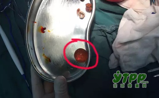 1岁男童误食“水宝宝” 取出既有乒乓球那么大