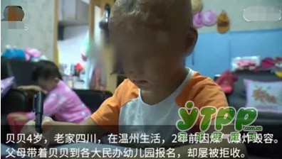 毁容男童艰难入学 你愿意让孩子和他玩吗