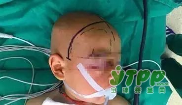 1岁男童摔下床致开颅手术 有调查显示跌落是造成儿童意外伤害的首要原因之一