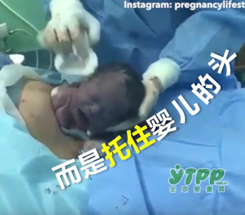 胎儿靠自己从妈妈肚子里出生 剖腹产伤口要如何护理