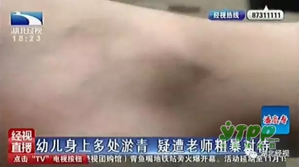 幼儿身上多处淤青 孩子在幼儿园又受委屈了