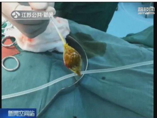 11岁男孩把零食当饭吃  医生成功"保胆取石"