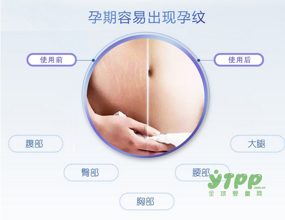 孕纹的防护永远大于修护 孕期防护刻不容缓