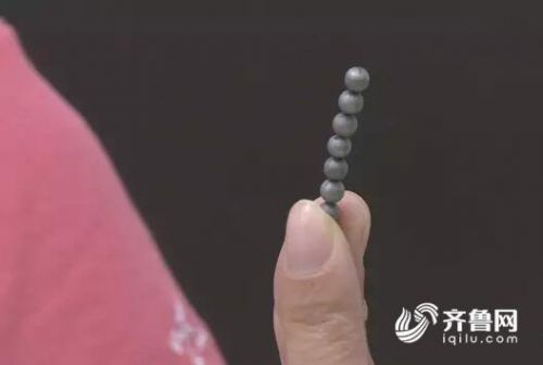 1岁3个月的宝宝误吞的6颗磁珠  腐蚀肠道造成穿孔严重化脓感染