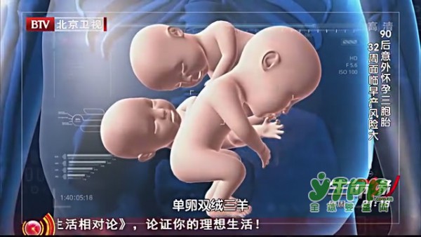 怀多胎的孕妈妈要了解：什么是单卵双绒三羊  有哪些危险