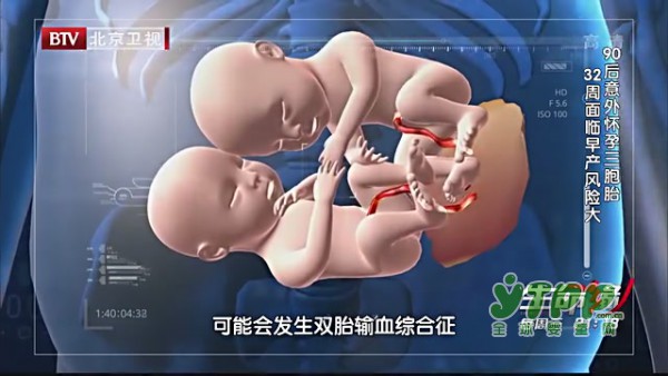 怀多胎的孕妈妈要了解：什么是单卵双绒三羊  有哪些危险