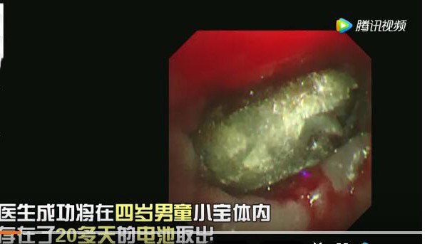 4岁小孩吞下电池险些丧命 儿童意外伤害处理措施大全