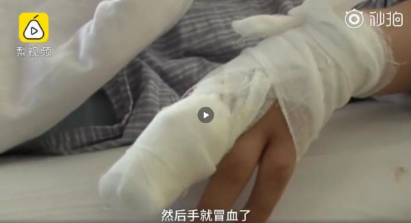 #用花椒面止血感染截肢#   不靠谱的“土方法”要警惕