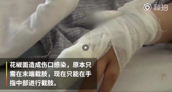 #用花椒面止血感染截肢#   不靠谱的“土方法”要警惕
