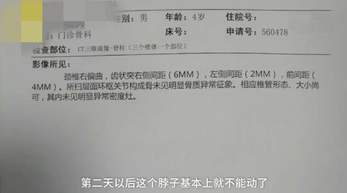 躺着玩手机太久, 男童变“歪头宝宝”