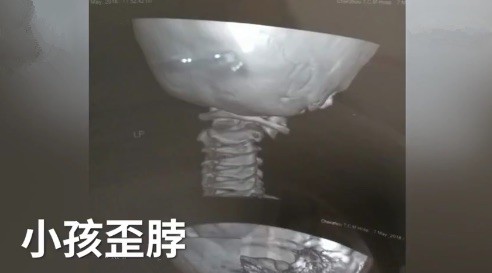 躺着玩手机太久, 男童变“歪头宝宝”
