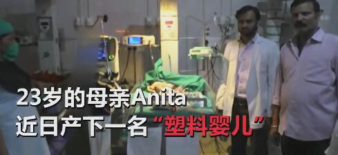 什么是板层状鱼鳞病 印度妈妈产下“塑料婴儿”--全身如蜡状