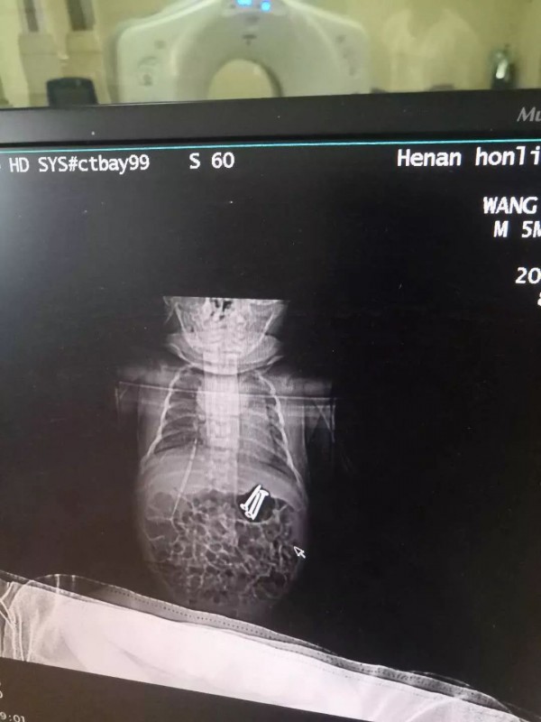 三岁大宝给小宝喂了3颗钉子 在家照顾孩子时应该注意什么