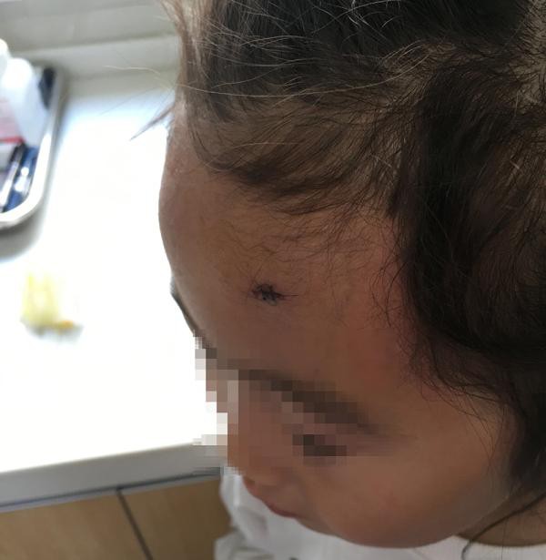 女童迪士尼撞八角形灯柱缝两针 园方：赔个毛绒玩具作为安慰