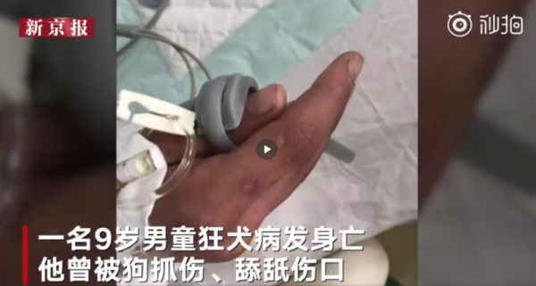 #官方回应男孩被狗舔伤口死亡#   如何预防狂犬病