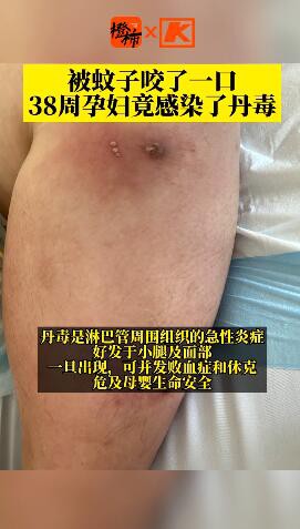 孕妇被蚊子叮咬抓挠后感染丹毒    什么是丹毒  患上丹毒应该注意什么