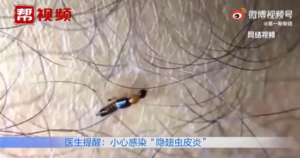 怎么辨认隐翅虫  遇隐翅虫千万不要拍打