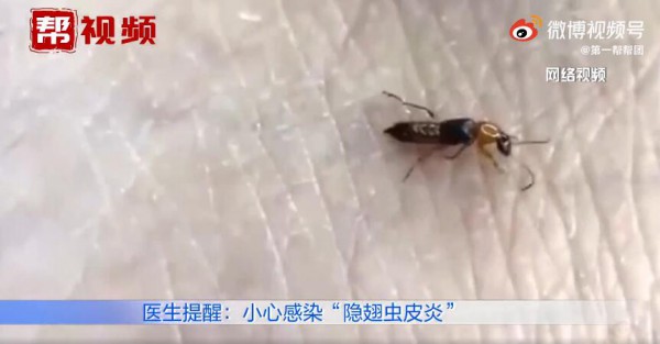 怎么辨认隐翅虫  遇隐翅虫千万不要拍打
