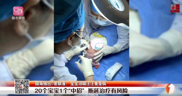 深圳4个月大婴儿眼角抽出5管脓液 宝宝泪眼汪汪竟是病……