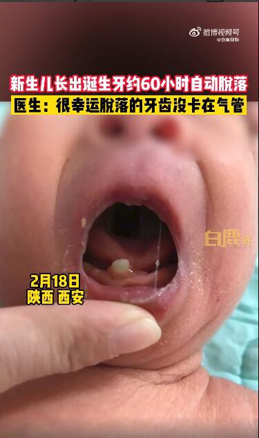 宝宝出生就有牙齿60小时后又自动脱落 如何处理早生齿