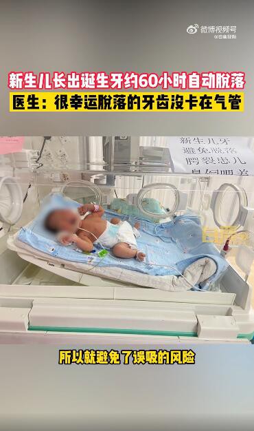 宝宝出生就有牙齿60小时后又自动脱落 如何处理早生齿