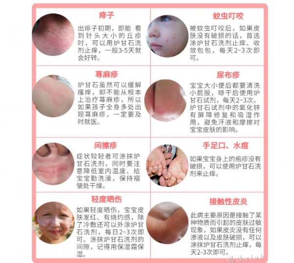 孩子常用的“万能”炉甘石不万能！切记，这4种情况千万别给宝宝用