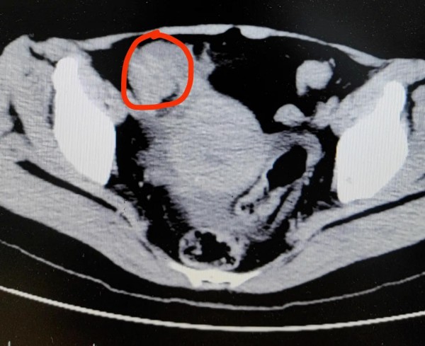 女子一口气吃3个柿子，痛到进医院，医生提醒：不能混吃、不能空腹吃