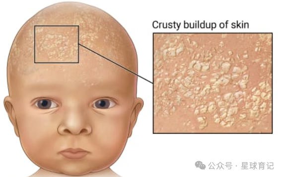 新生儿枕秃是因为缺钙吗？