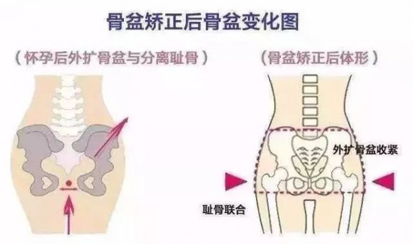 不做骨盆修复，老后的样子更可怕！！！
