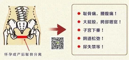 不做骨盆修复，老后的样子更可怕！！！