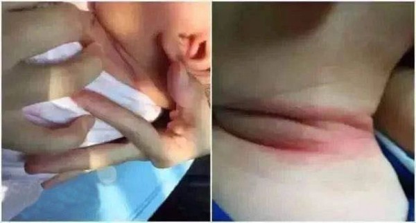 宝宝脖子淹了哭闹不止，竟是奶奶惹的祸，这种错误别再犯了