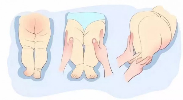 宝宝腿纹不对称怎么回事？腿纹不对称要不要紧？一文弄懂