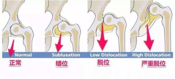 宝宝腿纹不对称怎么回事？腿纹不对称要不要紧？一文弄懂
