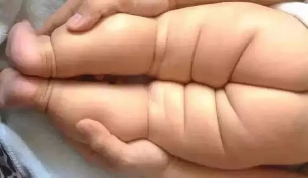 宝宝腿纹不对称怎么回事？腿纹不对称要不要紧？一文弄懂