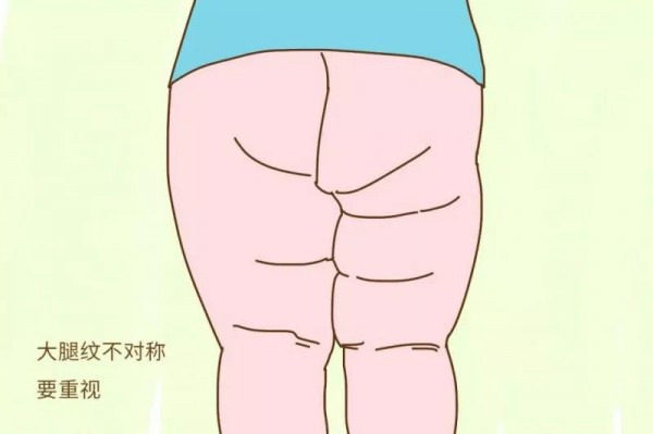 宝宝腿纹不对称怎么回事？腿纹不对称要不要紧？一文弄懂