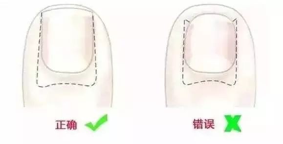 乱给孩子剪指甲后果很严重，十个妈妈里面有九个都剪错了！转给家长！