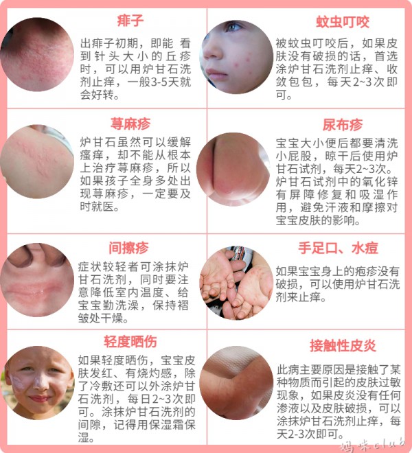 “万能”的炉甘石洗剂并非万能！这4种情况禁用！