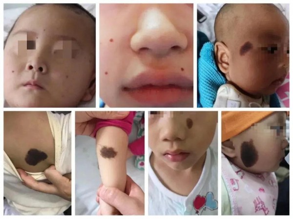 宝宝身上长这样的“痣”，千万别大意！