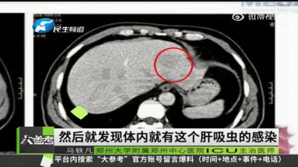 6岁男孩患上“肝吸虫病”，罪魁祸首居然是它，家家都有！