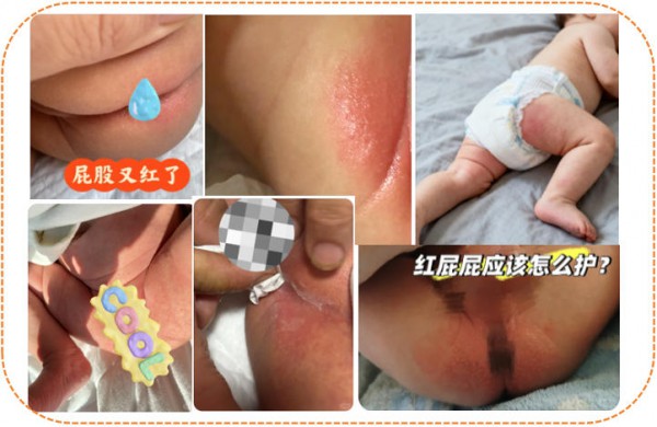 宝宝夏季红屁屁，先别怪纸尿裤！对照最新指南，真正原因是这5个